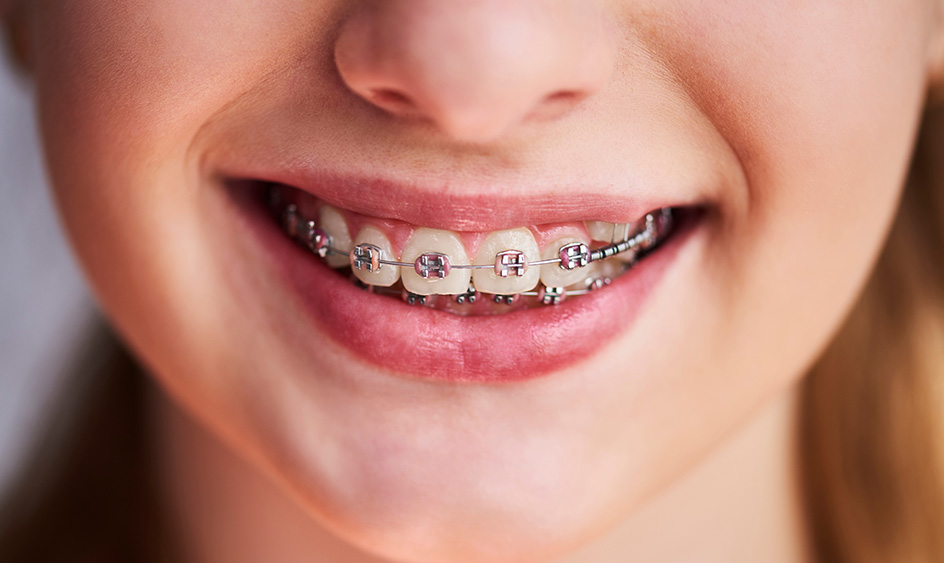 Let op: het Torque-gevaar na een beugelbehandeling